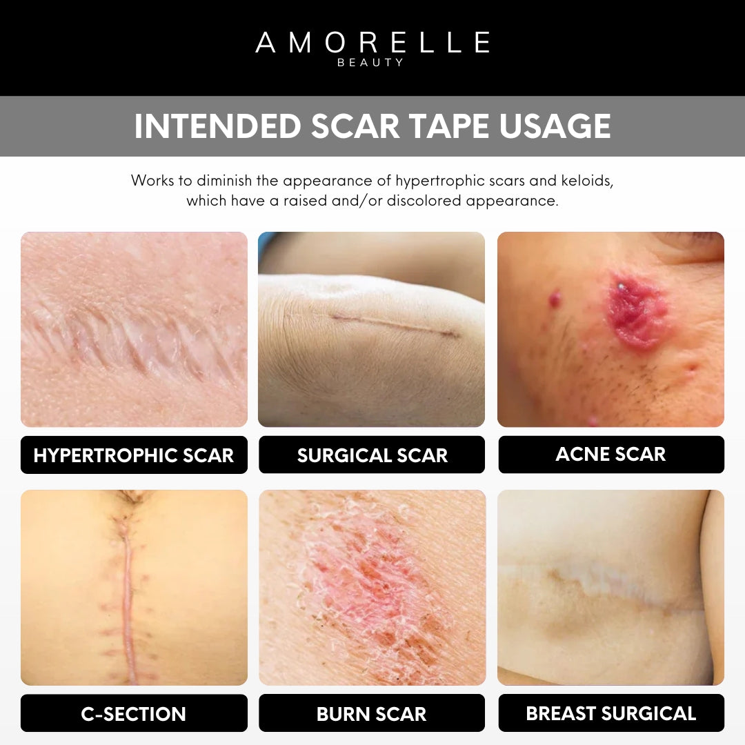 AMORELLE Advanced Silicone Scar Tape