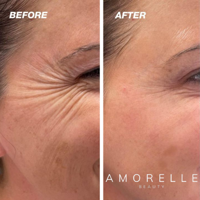 AMORELLE Advanced Silicone Scar Tape